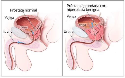Desinflamar la prostata