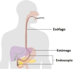 CPRE Endoscopio pancreas